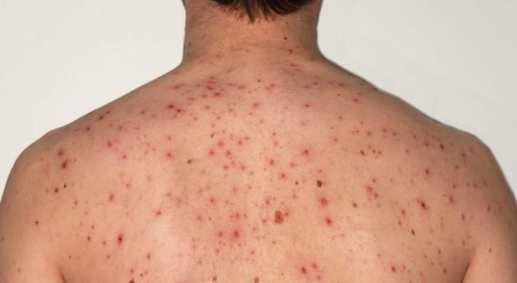 Casos de sarampo nas Américas crescem 32 vezes e acendem alerta