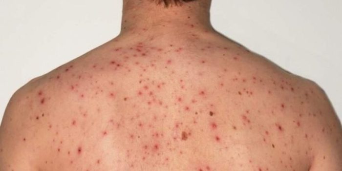 Casos de sarampo nas Américas crescem 32 vezes e acendem alerta